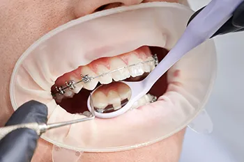 Brushing Techniques