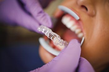 Invisalign Aligner